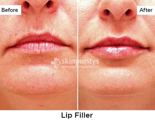 Lip Filler results